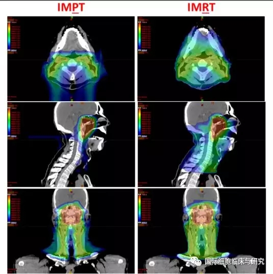 质子治疗和调强放疗对比