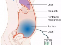 癌性腹水治疗,癌性腹水怎么治疗,癌性腹水怎么办