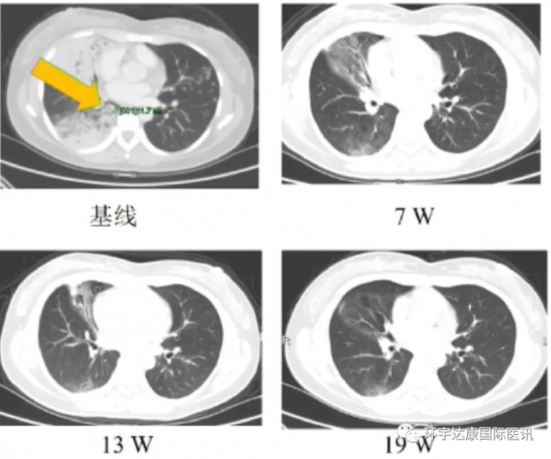 Taletrectinib治疗克唑替尼治疗失败患者的效果