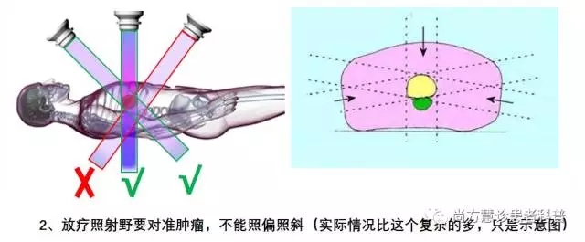 肿瘤放射治疗