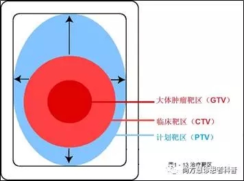 肿瘤放疗放射剂量靶区勾画