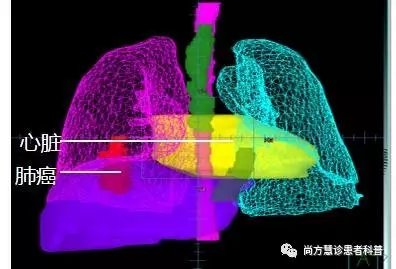 肺癌放疗三维靶区