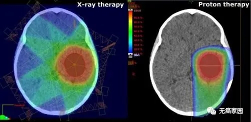 儿童脑瘤普通放疗和质子刀放疗对比