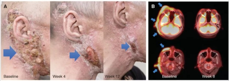 TPX-0005治疗NTRK融合分泌性唾液腺癌的效果