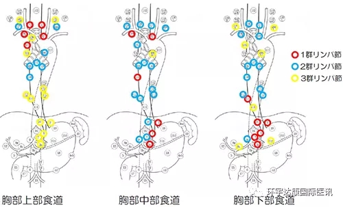 日本癌研有明医院治疗食管癌