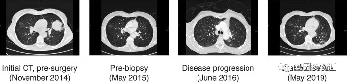 阿法替尼治疗肺癌EGFR20外显子突变患者的效果