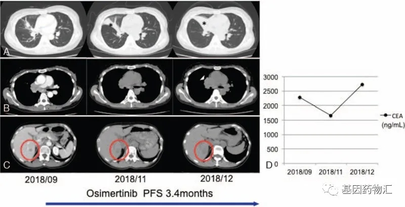 卡铂+培美曲塞+贝伐珠单抗肺癌EGFR20外显子突变患者的效果