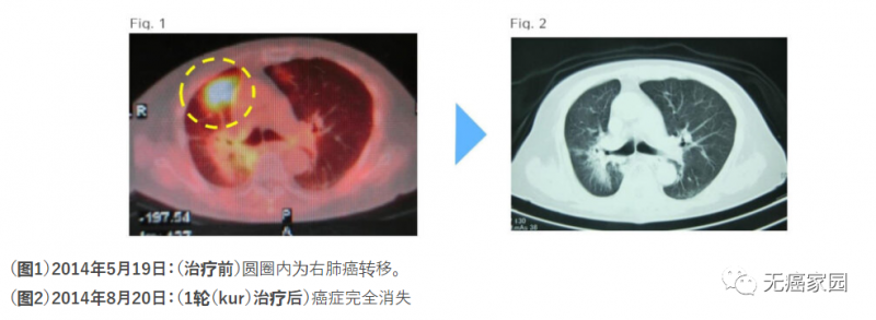 树突细胞疗法治疗胃癌的效果