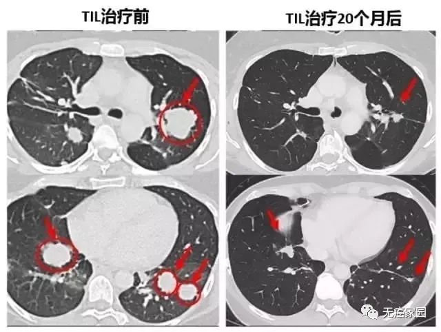 TIL细胞疗法治疗梅琳达肺转移的前后对比