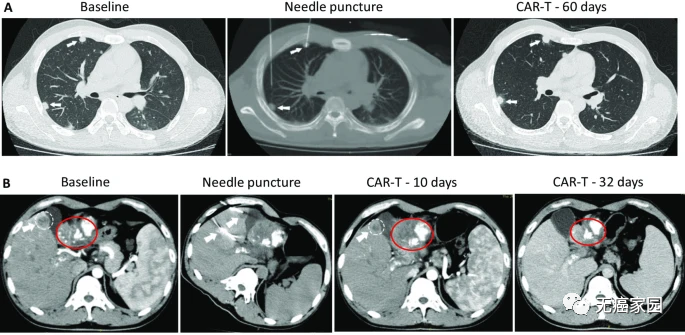 CAR-T细胞疗法治疗肝癌的效果