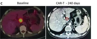 改良的CAR-T细胞疗法治疗胰腺癌的效果