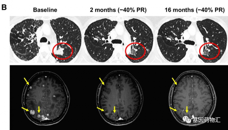 瑞波替尼治疗肺癌多发脑转移和色瑞替尼耐药的效果