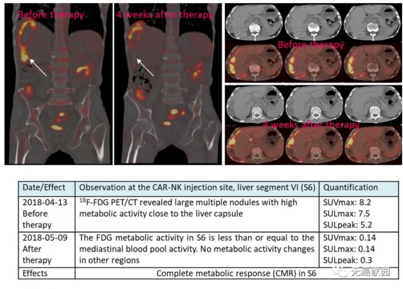 CAR-NK 细胞治疗后肝转移病灶PEC-CT结果对比图