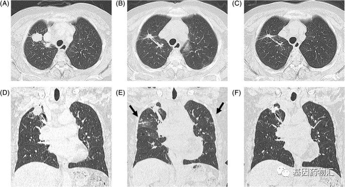 ROS1抑制剂治疗肺腺癌的效果