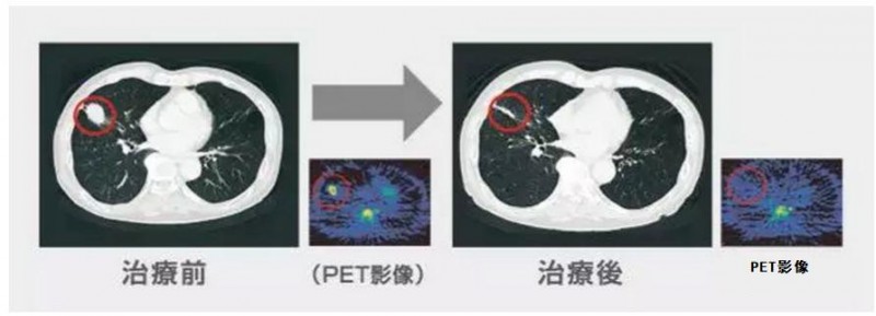 重离子治疗肺癌的案例