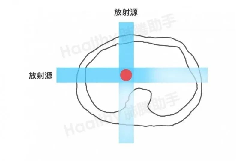 放疗