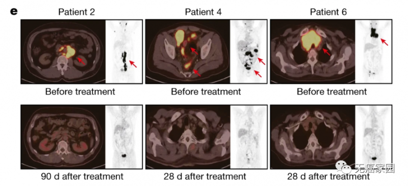 三位代表性患者治疗前后的PET-CT扫描