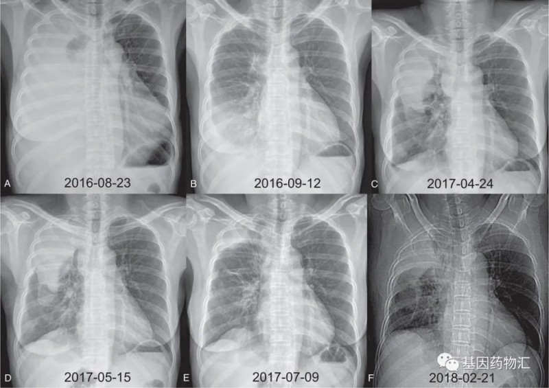 EGFR外显子21 L858R突变以及ALK重排治疗效果