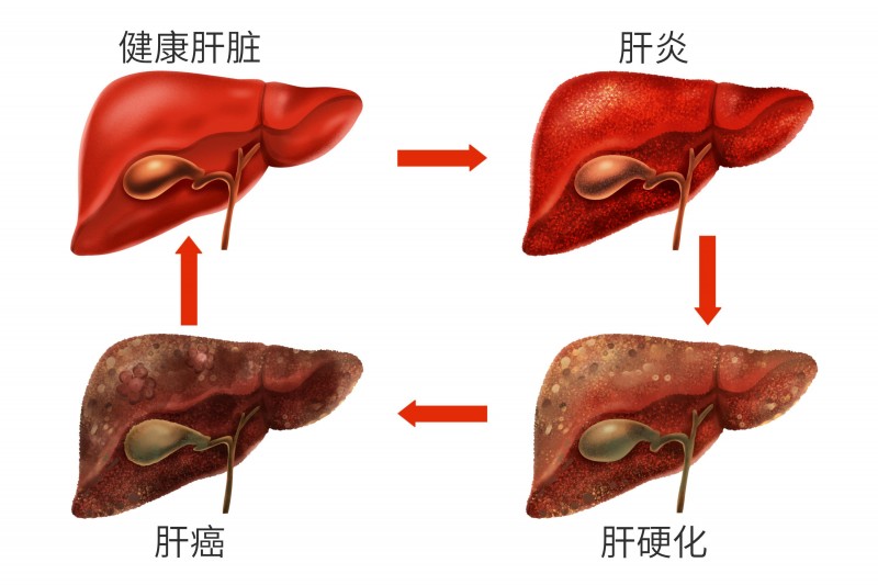 正常肝脏和患病肝脏对比