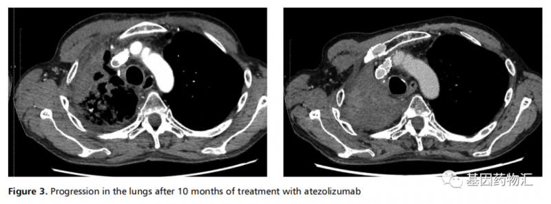 阿特珠单抗治疗肺腺癌的效果