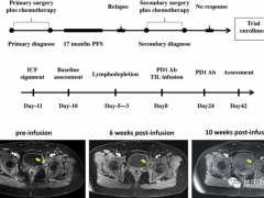 肿瘤浸润淋巴(TIL)细胞疗法治疗后10周病灶完全消失,新型免疫细胞疗法挽救多位晚期复发的患者