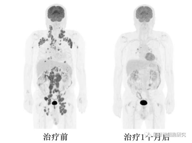 CAR-T疗法AT101治疗复发或难治性B细胞非霍奇金淋巴瘤的效果