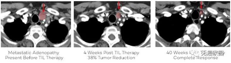 TIL细胞免疫疗法治疗非小细胞肺癌的效果