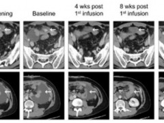 CT041治疗晚期胃癌:肿瘤病灶及腹水均改善