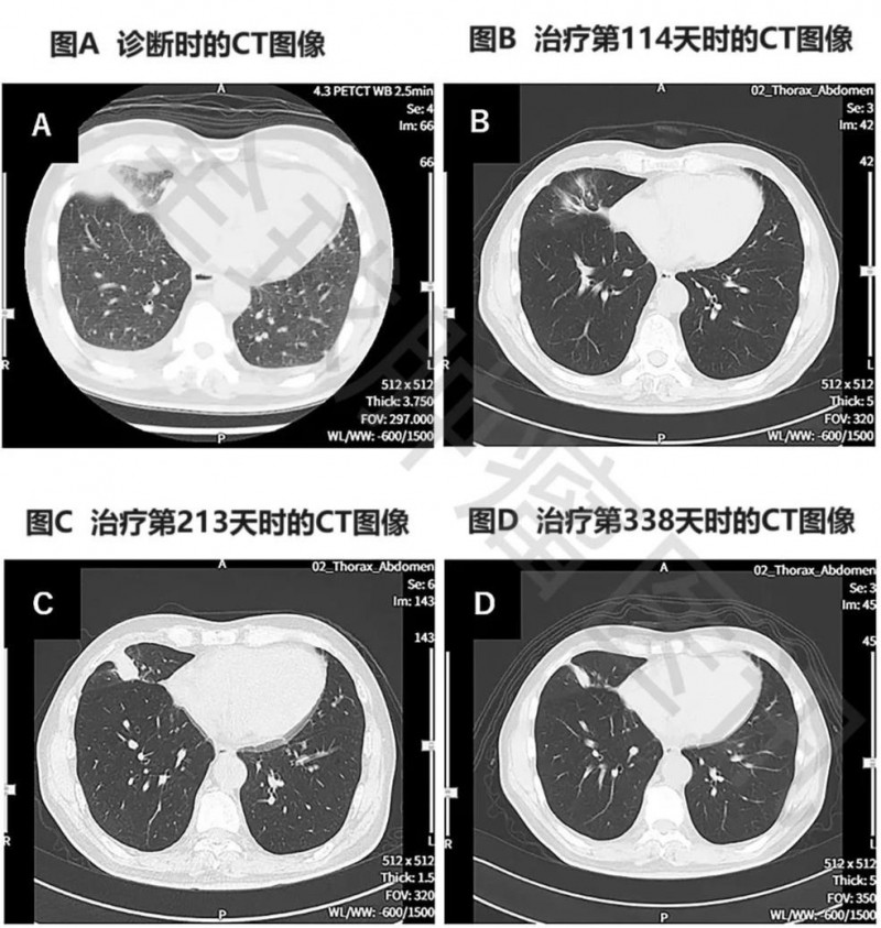 WT1-DC疫苗治疗肺癌的CT变化图