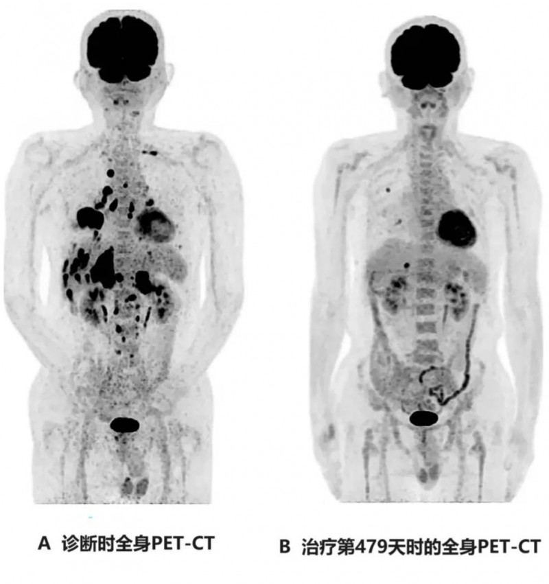WT1-DC疫苗治疗肺癌的全身PET-CT对比