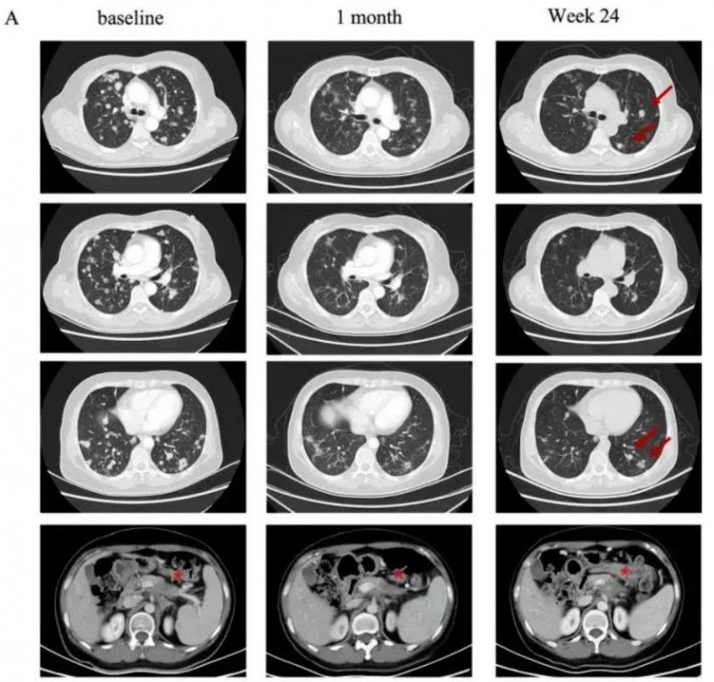 CT401治疗胰腺癌的效果