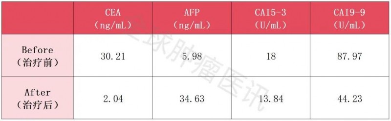 NK细胞治疗肝癌的数据变化