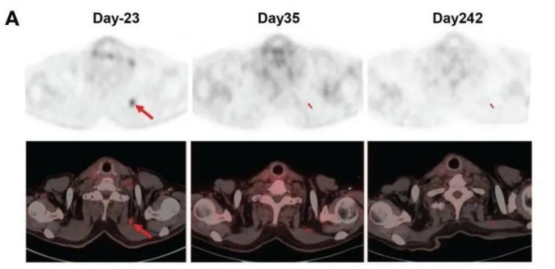 claudin18.2 CAR-T治疗胰腺导管癌的效果