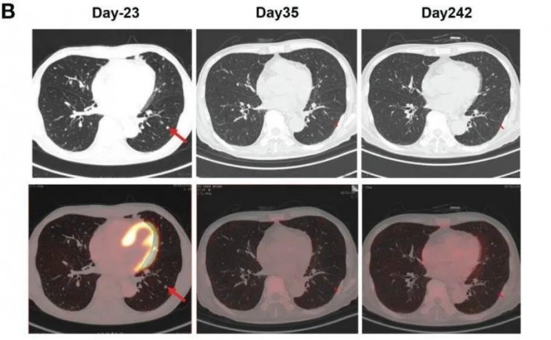 claudin18.2 CAR-T治疗后肺部淋巴结的变化