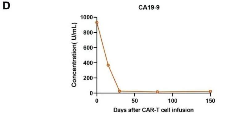 claudin18.2 CAR-T治疗后的CA19-9的水平变化