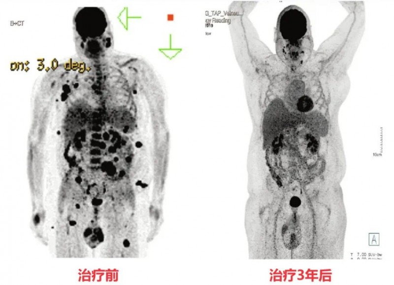 TIL细胞疗法治疗黑色素瘤的效果