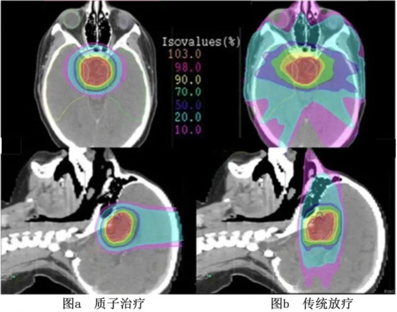 颅咽管瘤病例质子治疗与IMRT照射剂量对比图