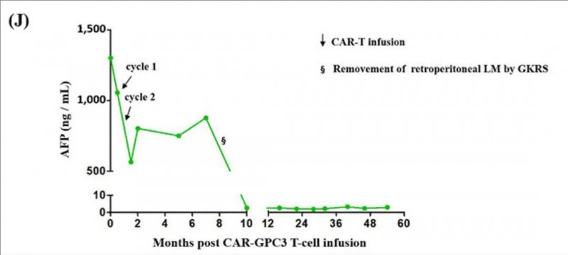 CAR-GPC3 T细胞治疗肝癌的数据