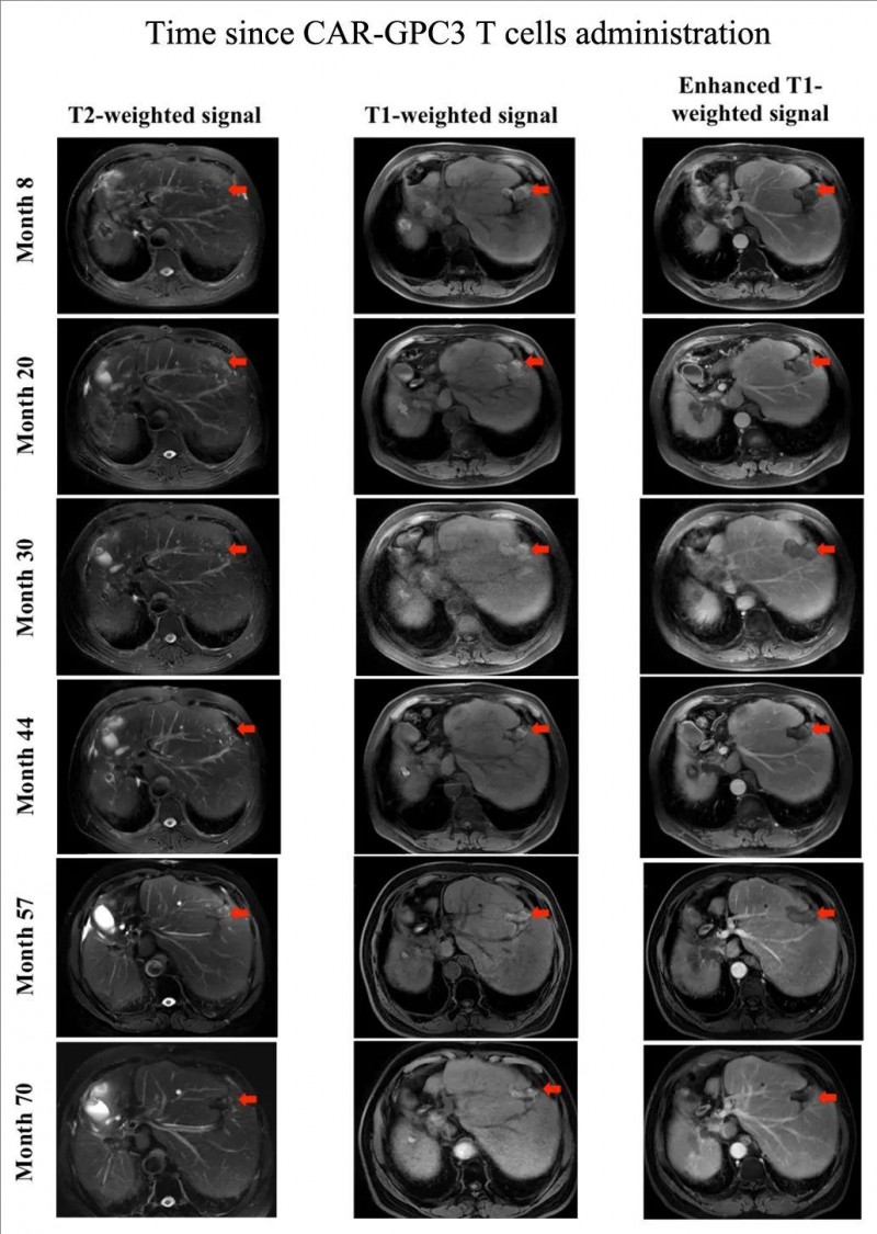 CAR-GPC3 T细胞治疗肝癌的效果