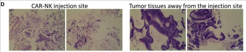 CAR-NK治疗结直肠癌后的病理活检