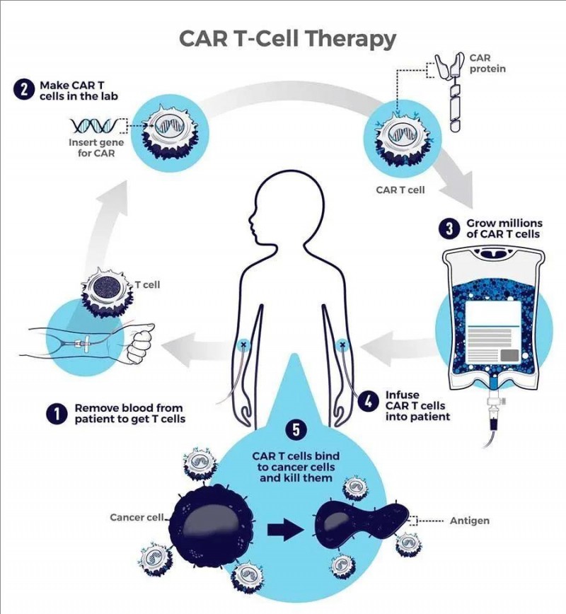 CAR-T治疗流程