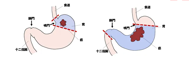 癌研有明医院的胃癌手术