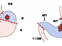 日本治疗胃癌晚期案例