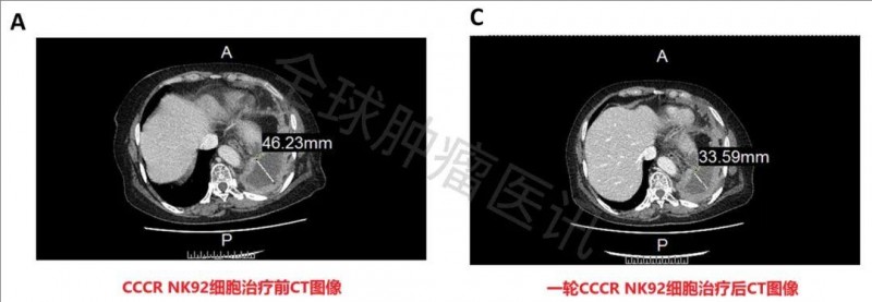 CAR-NK细胞疗法治疗肺癌的效果