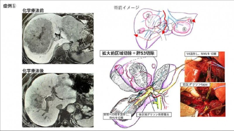 日本肠癌肝转移手术