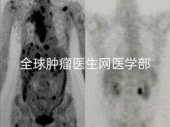 革命性广谱抗癌药硫酸拉罗替尼胶囊(Larotrectinib、Vitrakvi)仅8周患者全身肿瘤奇迹消失