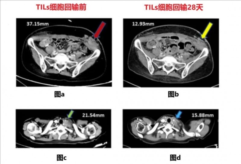 TIL细胞疗法治疗宫颈癌的效果