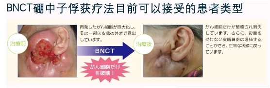 bnct