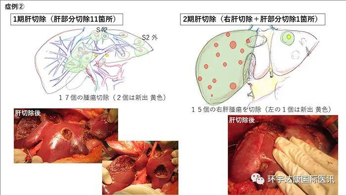 肝癌手术却出