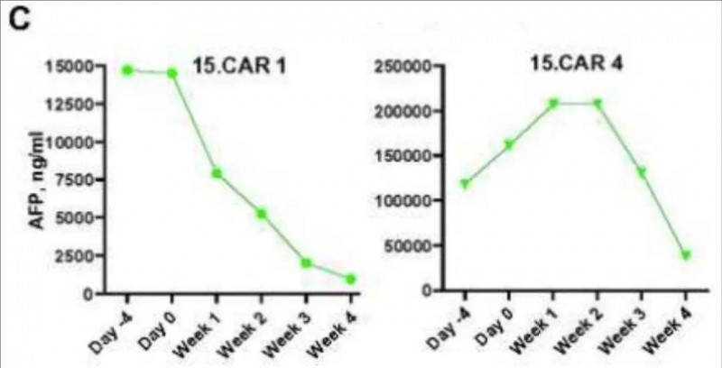 CAR-T治疗后的血清AFP浓度变化